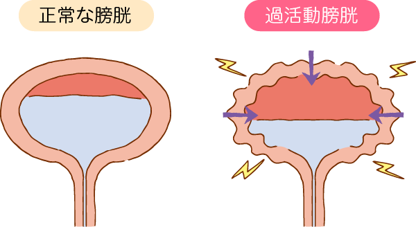 正常な膀胱と過活動膀胱のイラスト画像